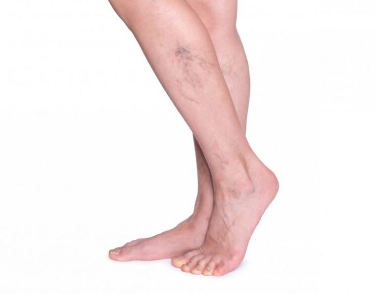 Varicose veins before varicone treatment