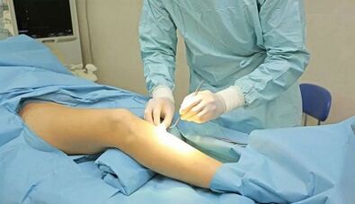 As an operation is performed with varicose veins