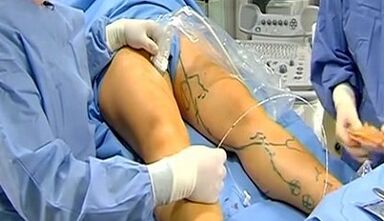 Operation for veins varicose veins