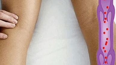 The reasons for the development of varicose veins of the lower ends