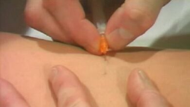 Varicose veins methods of the lower ends